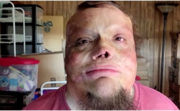 Doživio je užasnu nesreću u djetinjstvu