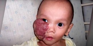 Dijete s tumorom na licu su dali na posvajanje