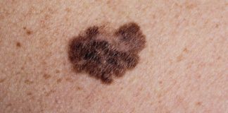 Kako prepoznati melanom