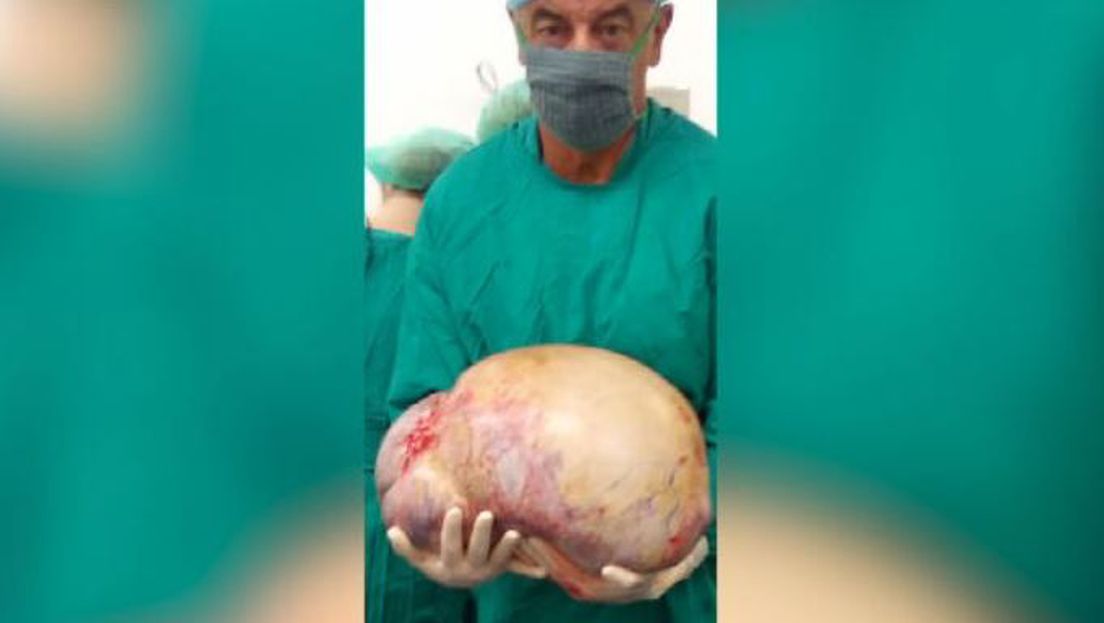 Tumor od 20 kilograma