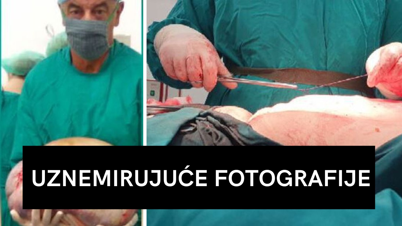 Tumor težak 20 kilograma