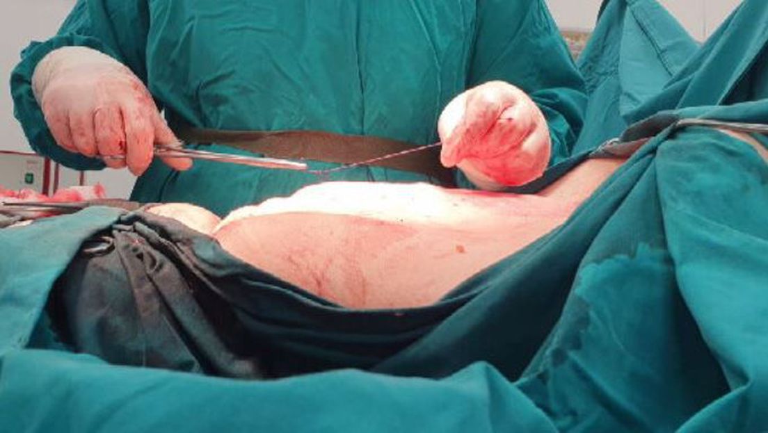 Ženin trbuh nakon operacije
