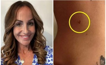 Mama oboljela od melanoma ima važno upozorenje za sve koji se "igraju s vatrom"