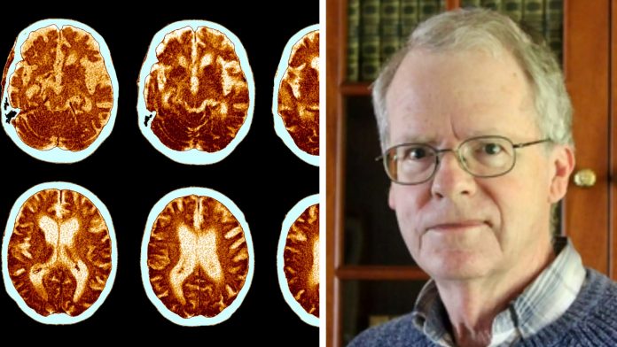Bivši neurolog prepoznao rane simptome Alzheimerove bolesti