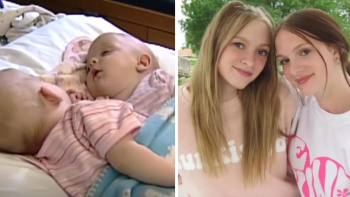 Sijamske blizanke podijelile kako se osjećaju 10 godina nakon razdvajanja