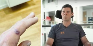Nijemac zbog male posjekotine ostao bez ruku i nogu