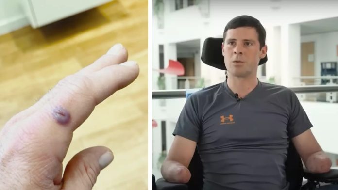 Nijemac zbog male posjekotine ostao bez ruku i nogu