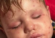 Dječak (2) se bori za život nakon 150 uboda: "Koža mu je požutjela, organi su zatajili..."