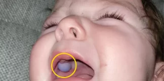 Zapanjeni liječnici mislili su da beba ima tumor u ustima