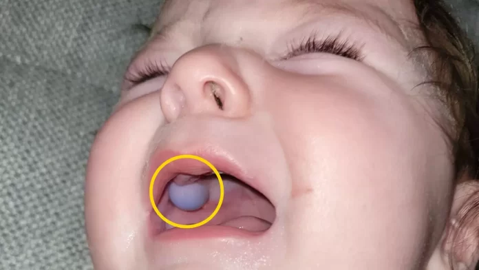Zapanjeni liječnici mislili su da beba ima tumor u ustima