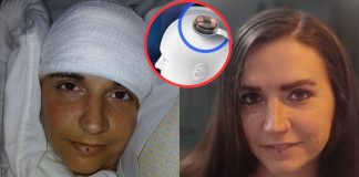 Ženi ugrađen čip u mozak