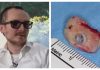 Doktori mu vratili vid nakon 20 godina: 'U oko su mi ugradili zub'