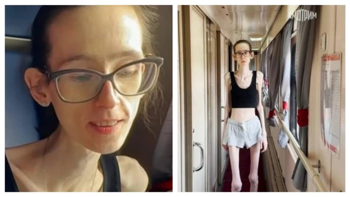 Ova djevojka je željela biti mršava da bi postala popularna u školi: Sada ima 29 kilograma na 176 cm visine