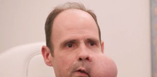 Muškarac s tumorom na licu molio je pomoć, liječnici su mu rekli da će umrijeti