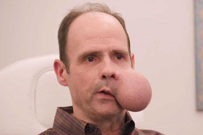 Muškarac s tumorom na licu pomoć