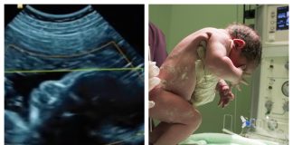 Bebi usred porođaja izvadili tumor veličine glave