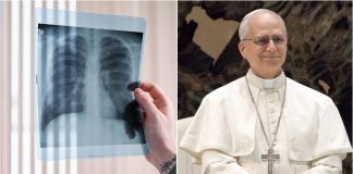 Rak pluća dijagnosticiran papi pogađa i nepušače – evo što trebate znati
